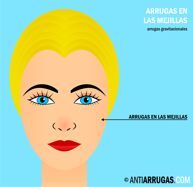 arrugas en las mejillas